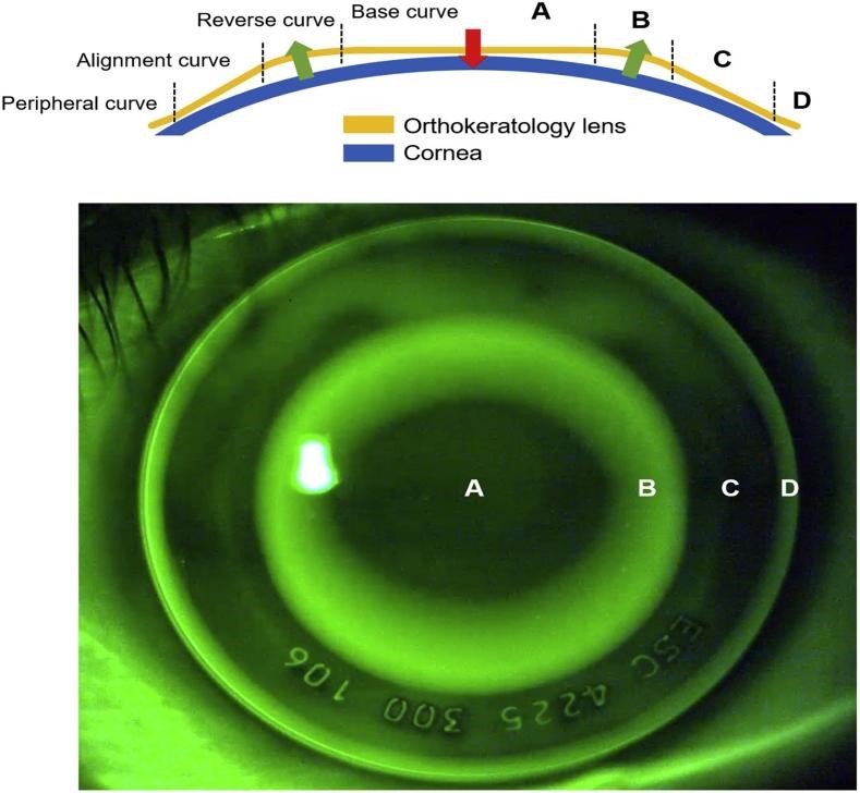 Effect Of OrthoK Lenses On Myopia Correction Sushant University blog